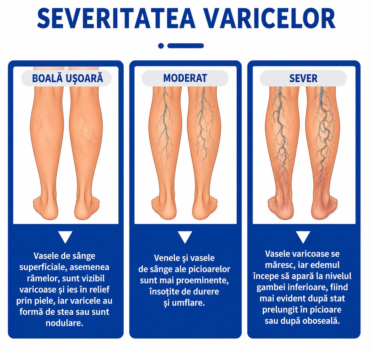 Cremă pentru Picioare Varicose